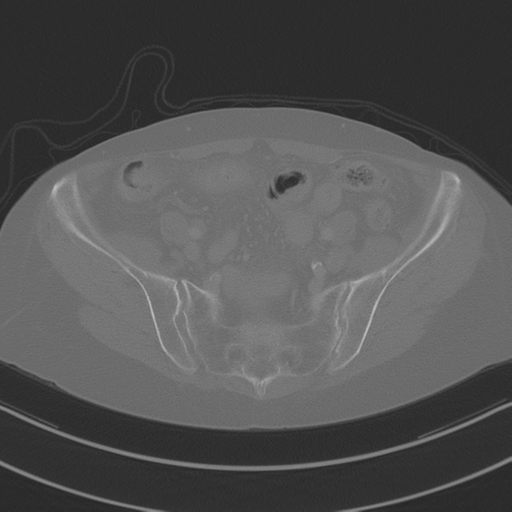 April fools' 2019- calcified peritoneal arachnoidosis (Radiopaedia 67273-76636 Axial bone window 39).png