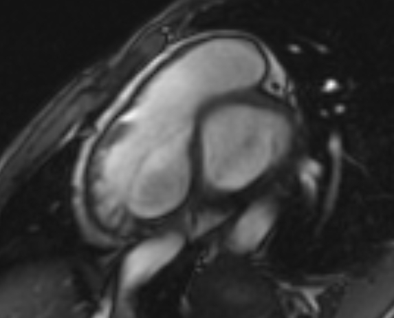 Arrhythmogenic right ventricular cardiomyopathy (Radiopaedia 69564-79464 short axis cine 232).jpg