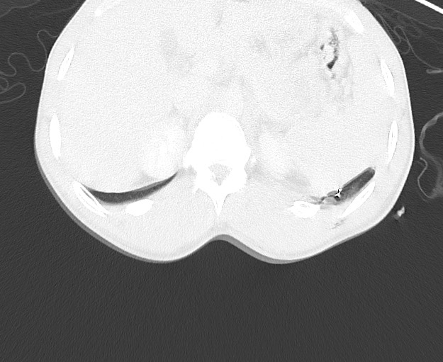 File:Arrow injury to the chest (Radiopaedia 75223-86321 Axial lung window 107).jpg
