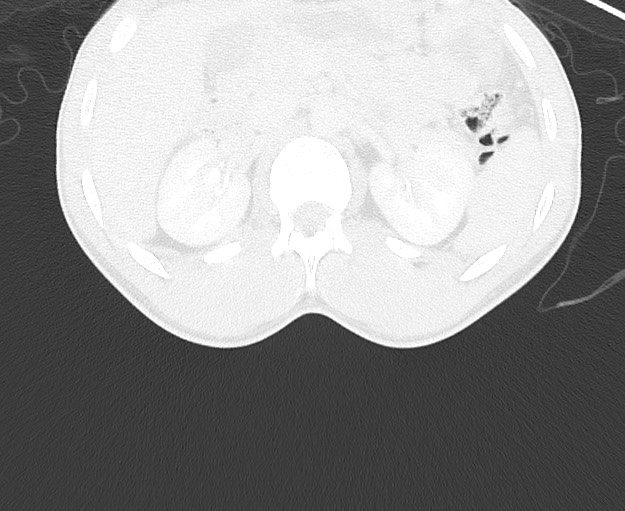 File:Arrow injury to the chest (Radiopaedia 75223-86321 Axial lung window 120).jpg