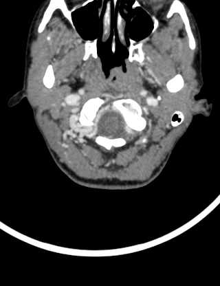 File:Arteriovenous malformation of the neck (Radiopaedia 53935-60062 B 2).jpg