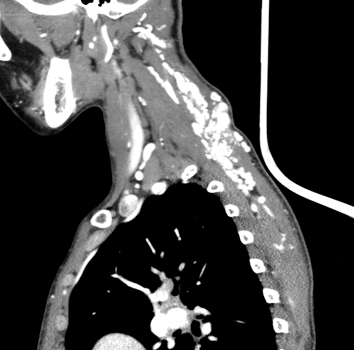 Arteriovenous malformation of the neck (Radiopaedia 53935-60062 C 30).jpg