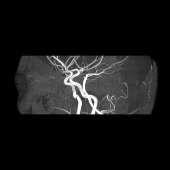 File:Artery of Percheron infarct (Radiopaedia 40966-43676 G 53).jpg