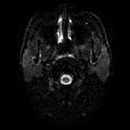 File:Artery of Percheron infarction (Radiopaedia 27975-28230 Axial DWI 26).jpg
