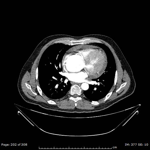 Ascending aortic aneurysm (Radiopaedia 50086-55404 A 53).jpg