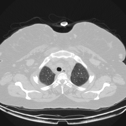 Aspergilloma (Radiopaedia 39611-41932 Axial lung window 12).jpg