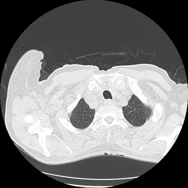 Aspergilloma (Radiopaedia 44592-48327 Axial lung window 2).jpg