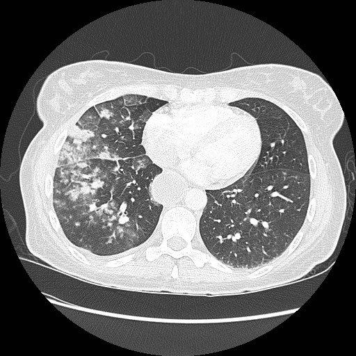 Aspiration pneumonia secondary to laparoscopic banding (Radiopaedia 18345-18183 lung window 75).jpg