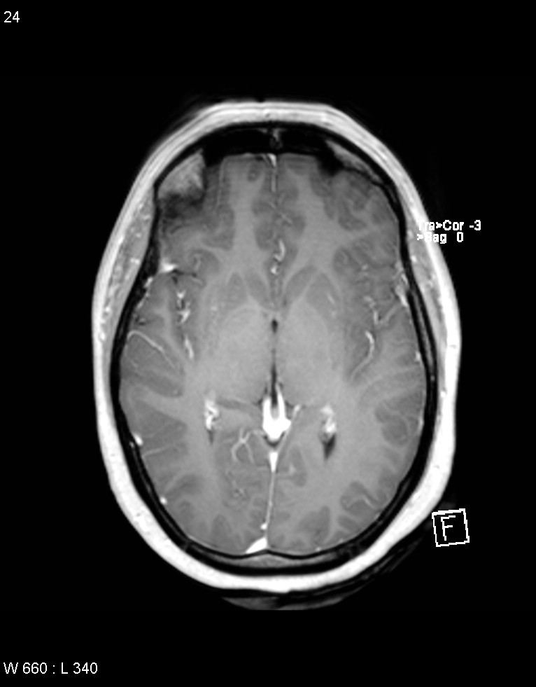 Astroblastoma (Radiopaedia 39792-42218 Axial T1 C+ 23).jpg