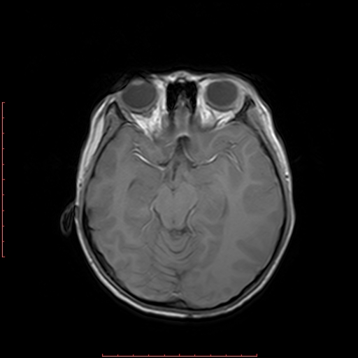 File:Astroblastoma (Radiopaedia 74287-85162 Axial T1 8).jpg