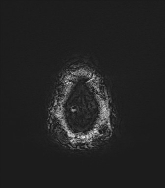 Astrocytoma (Radiopaedia 85660-101440 Axial SWI 85).jpg