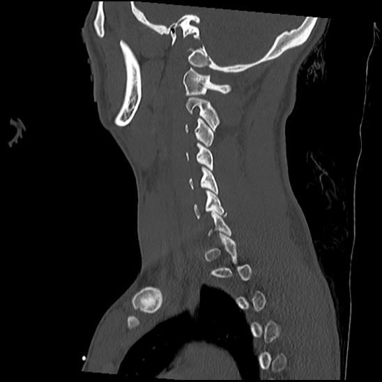 Atlanto-occipital dissociation (Traynelis type 1), C2 teardrop fracture, C6-7 facet joint dislocation (Radiopaedia 87655-104061 Sagittal bone window 47).jpg