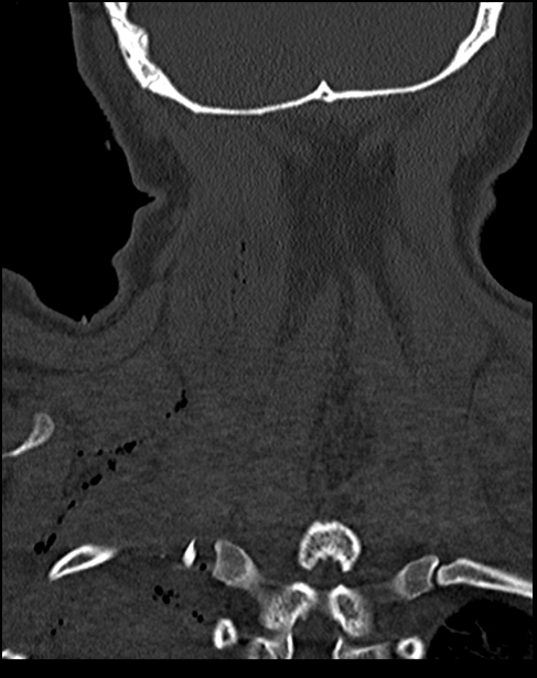Atlanto-occipital dissociation - Traynelis type 1 (Radiopaedia 87570-103948 Coronal bone window 49).jpg
