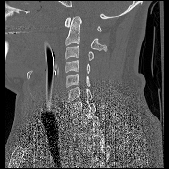 Atlanto-occipital dissociation injury (Radiopaedia 29274-29698 Sagittal bone window 27).png