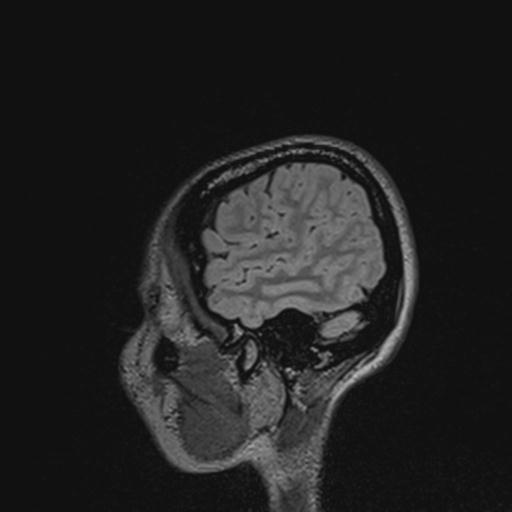 Atretic encephalocoele with inferior vermis hypoplasia (Radiopaedia 30443-31108 Sagittal FLAIR 132).jpg