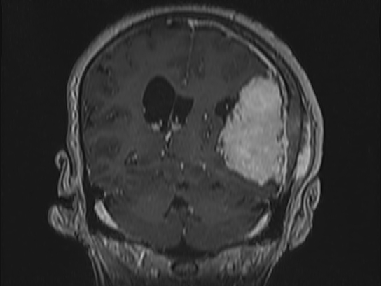 Atypical meningioma (Radiopaedia 62985-71406 Coronal T1 C+ 79).jpg