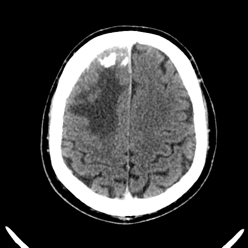 Atypical meningioma (WHO grade II) with brain invasion (Radiopaedia 57767-64728 Axial C+ 15).png
