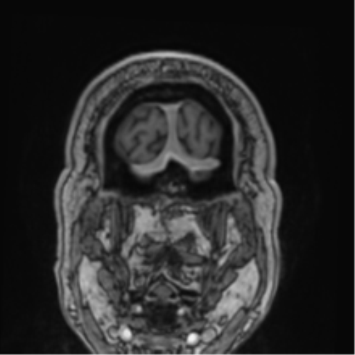 Atypical meningioma (WHO grade II) with brain invasion (Radiopaedia 57767-64729 Coronal T1 C+ 80).png