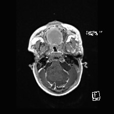 Atypical teratoid rhabdoid tumor (prenatal US and neonatal MRI) (Radiopaedia 59091-66388 Axial T1 C+ 12).jpg