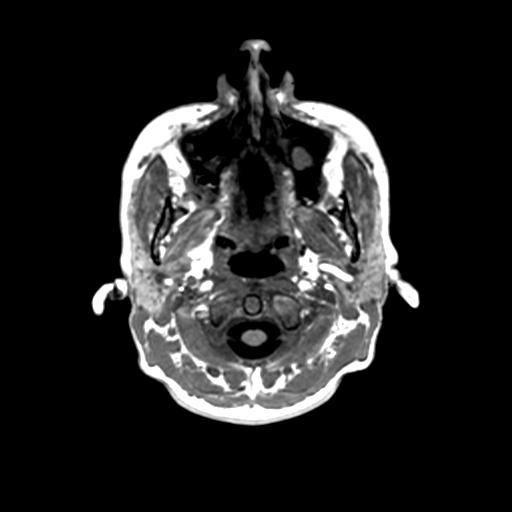 File:Autoimmune limbic encephalitis (Radiopaedia 30363-31005 T1 Axial 1mm 2).jpg