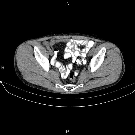Autoimmune pancreatitis (Radiopaedia 84925-100431 Axial non-contrast 48).jpg