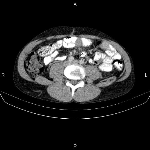 Autoimmune pancreatitis (Radiopaedia 84925-100431 B 34).jpg