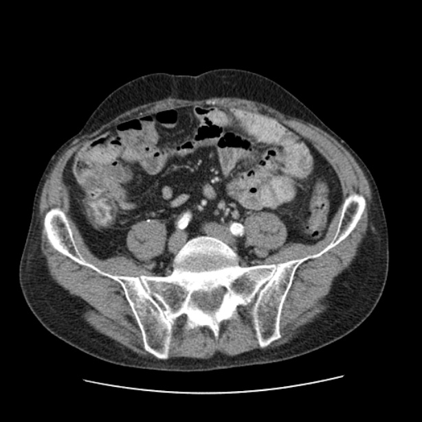Autosomal dominant polycystic kidney disease (Radiopaedia 27851-28094 B 93).jpg
