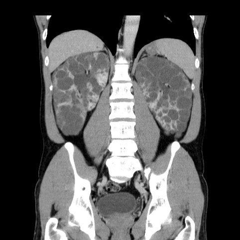 Autosomal dominant polycystic kidney disease (Radiopaedia 66349-75582 A 58).jpg