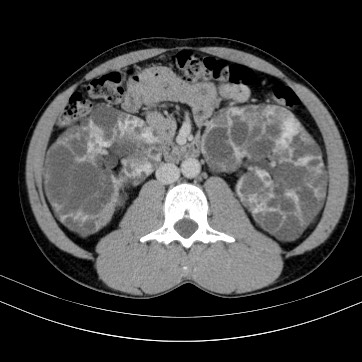 Autosomal dominant polycystic kidney disease (Radiopaedia 66349-75582 B 48).jpg