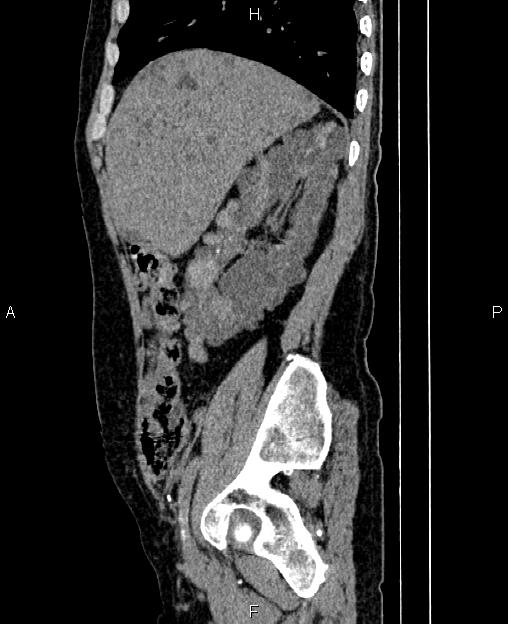 Autosomal dominant polycystic kidney disease (Radiopaedia 87830-104287 C 23).jpg