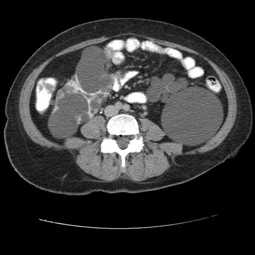 Autosomal dominant polycystic kidney disease with hepatic involvement (Radiopaedia 32693-33662 C 49).jpg