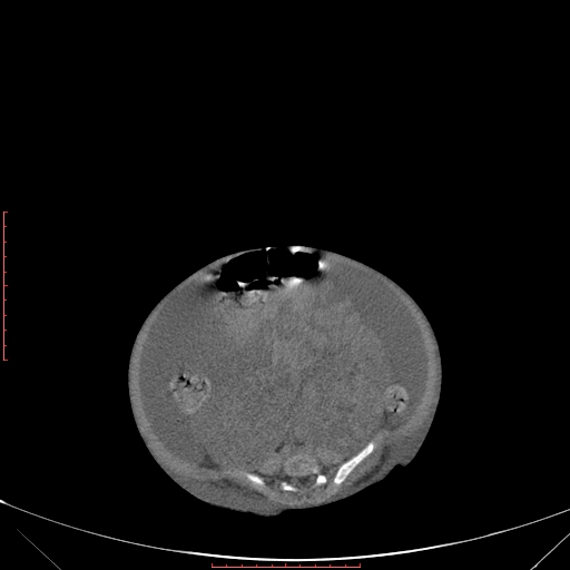 Autosomal recessive polycystic kidney disease associated with Caroli disease (Radiopaedia 61932-69984 B 266).jpg