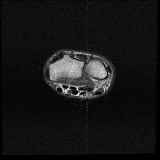 File:Avascular necrosis - scaphoid non-union (Radiopaedia 63457-72065 Axial T1 18).jpg