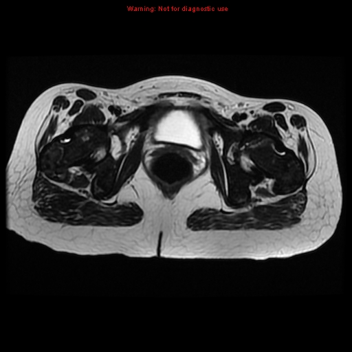 File:Avascular necrosis in sickle cell disease (Radiopaedia 17448-17151 Axial T2 11).jpg
