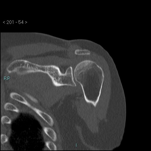 Avascular necrosis of the shoulder - Cruess stage I (Radiopaedia 77674-89887 Coronal bone window 53).jpg