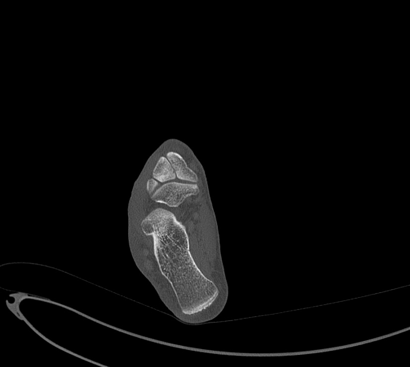 Avulsion fractures of talus and calcaneus (Radiopaedia 48277-53155 Axial bone window 72).jpg