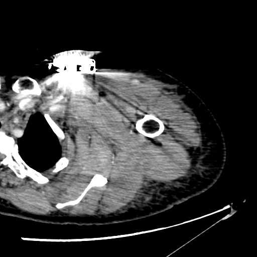 File:Axillary arterial pseudoaneurysm (Radiopaedia 24925-25195 A 4).jpg