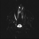 Balo concentric sclerosis (Radiopaedia 50458-55940 Axial DWI 22).jpg