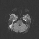 Balo concentric sclerosis (Radiopaedia 50458-55940 Axial DWI 62).jpg