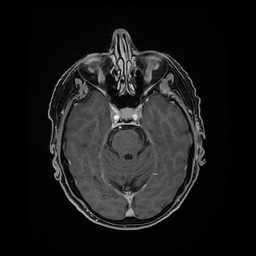 Balo concentric sclerosis (Radiopaedia 53875-59982 Axial LAVA C+ 89).jpg