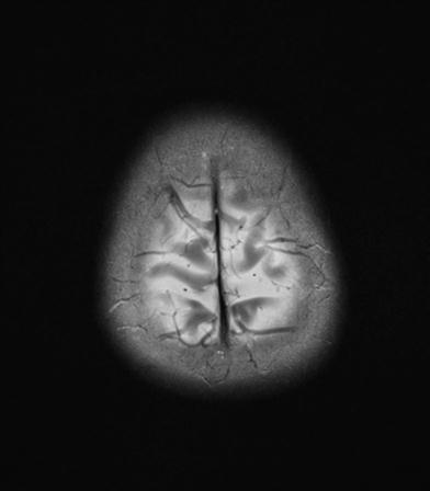 File:Base of skull chondrosarcoma (Radiopaedia 30410-31070 Axial T2 20).jpg