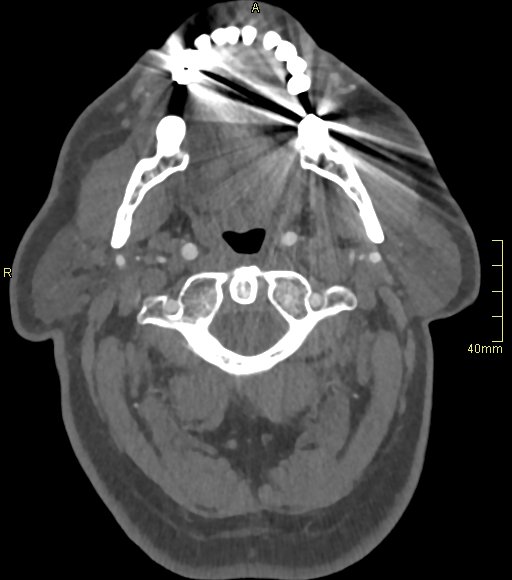 Basilar artery aneurysm (Radiopaedia 56261-62932 A 24).jpg