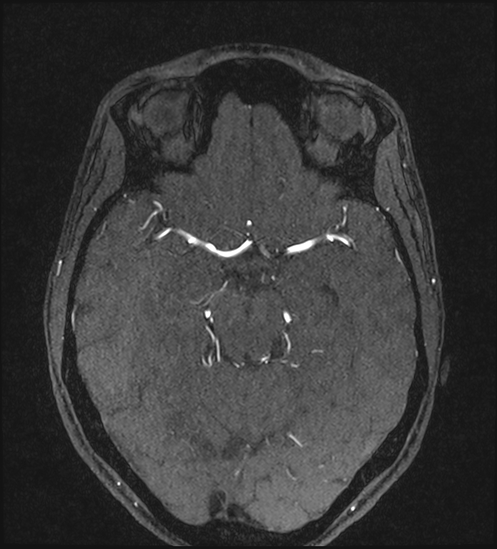Basilar artery perforator aneurysm (Radiopaedia 82455-97733 Axial MRA 104).jpg