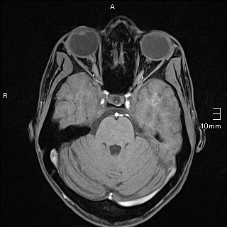 Basilar artery perforator aneurysm (Radiopaedia 82455-99523 F 42).jpg