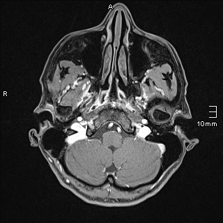 Basilar artery perforator aneurysm (Radiopaedia 82455-99523 G 10).jpg