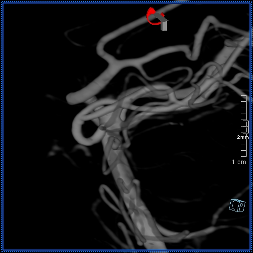 Basilar artery perforator aneurysm (Radiopaedia 82455-99524 3D Left VA 12).jpg