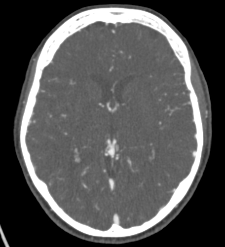 File:Basilar tip aneurysm with coiling (Radiopaedia 53912-60086 A 79).jpg