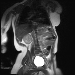 File:Beckwith-Wiedeman syndrome with bilateral Wilms tumors (Radiopaedia 60850-69233 B 13).jpg