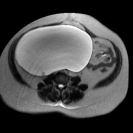 File:Benign seromucinous cystadenoma of the ovary (Radiopaedia 71065-81300 Axial T2 1).jpg