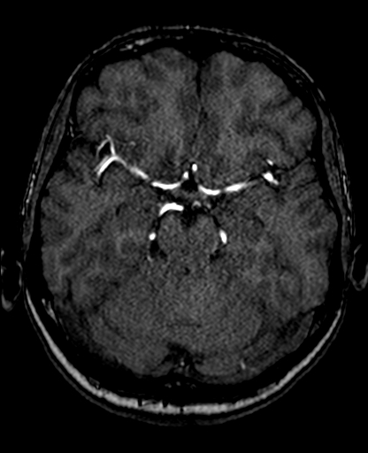 File:Berry aneurysm of the terminal internal carotid artery (Radiopaedia 88286-104918 Axial TOF 101).jpg